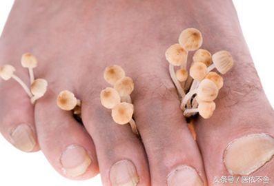 真菌不除,脚气难消,补充维生素和矿物质抑制真菌繁殖