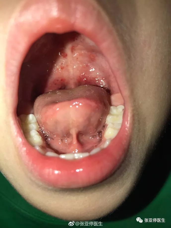 儿童疱疹性咽峡炎呼吸急促,医生说疱疹性咽峡炎