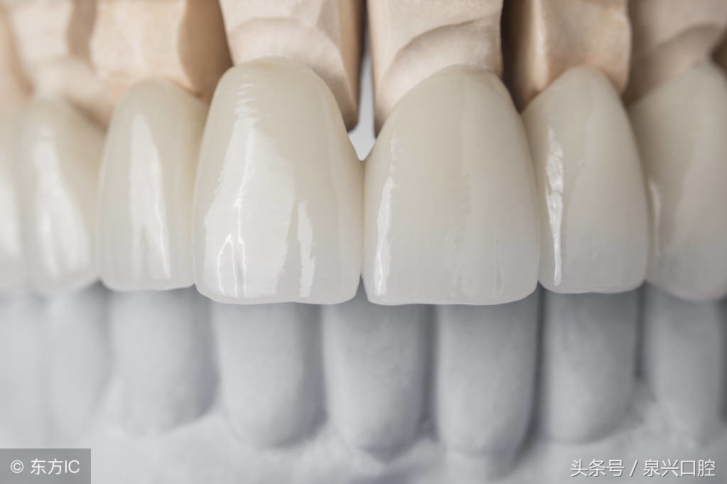 烤瓷牙优缺点,为什么不建议做烤瓷牙而是全瓷牙