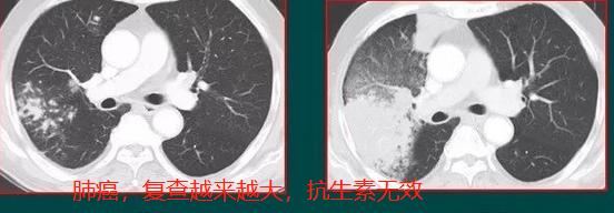 肺部3厘米的肿块是肺癌早期吗,肺上长出30cm肿块应该怎么办