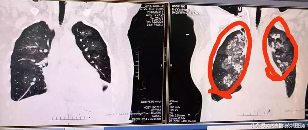 女性45岁反复发作性咳喘10余年,41岁女性反复咳嗽