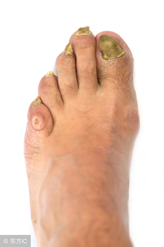 灰指甲祛除病甲后需要注意什么,和灰指甲患者接触应该注意什么