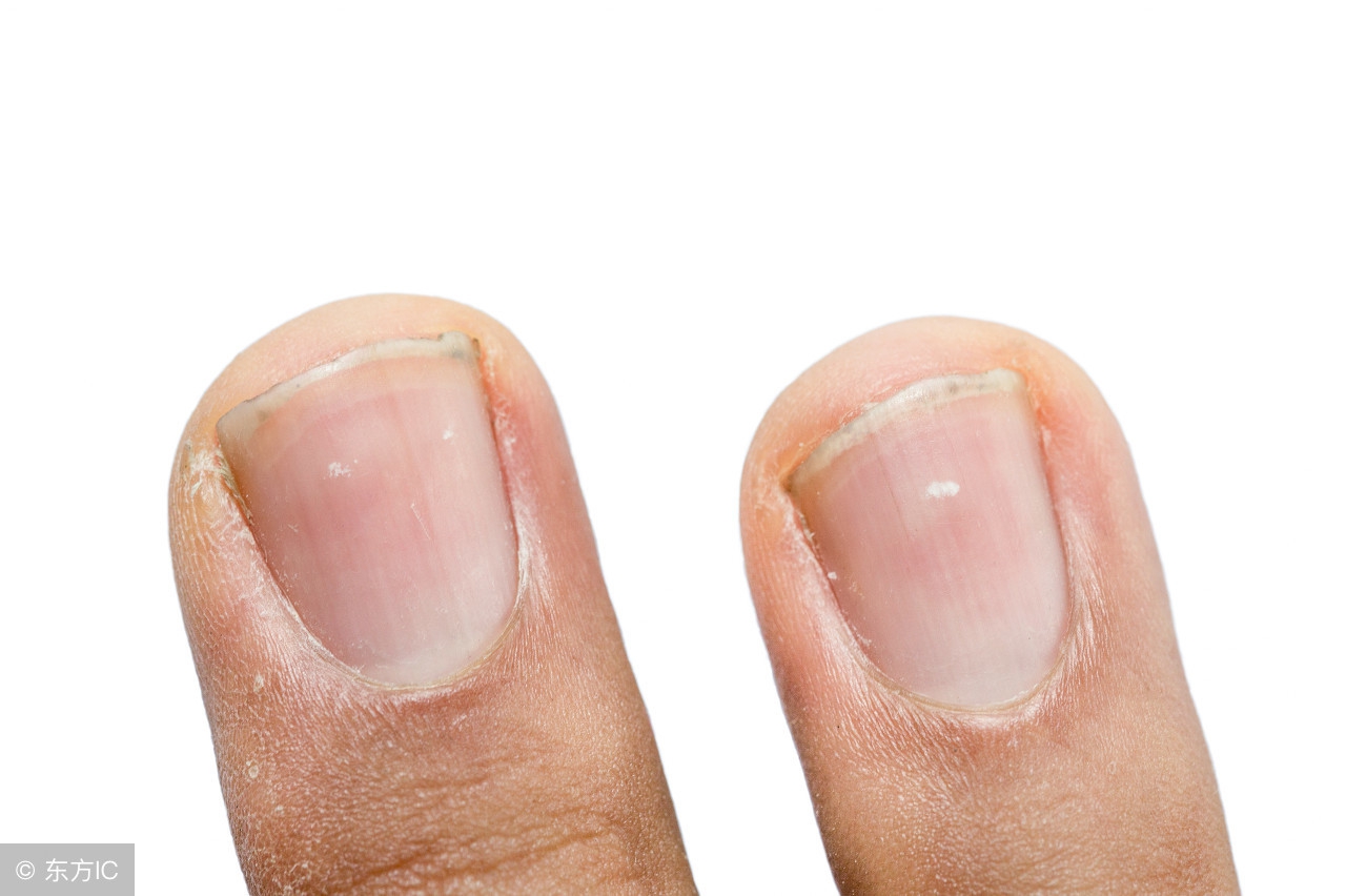 灰指甲祛除病甲后需要注意什么,和灰指甲患者接触应该注意什么