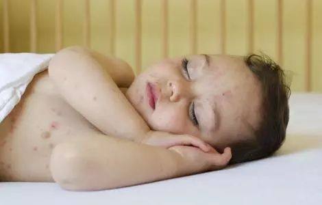 去医院看湿疹都要检查什么,宝宝爱起湿疹怎么回事