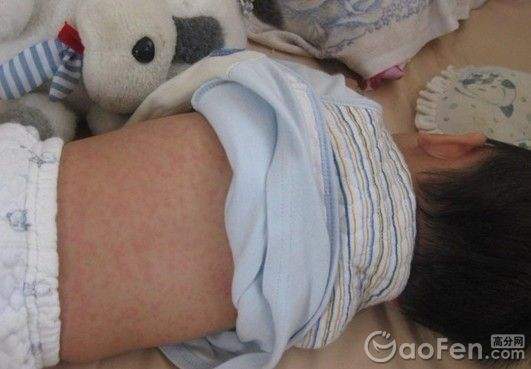 婴幼儿急疹需要注意什么,怎么判断婴幼儿急疹