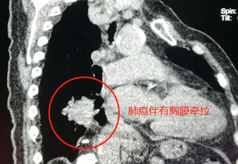 肺癌脑部转移还有脑血栓,脑梗查出肺结节怀疑肺癌
