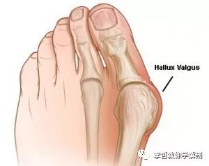 拇外翻该怎么办,拇外翻的解决方法