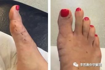 拇外翻该怎么办,拇外翻的解决方法