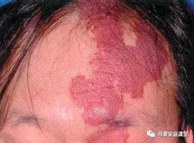 红色血管瘤胎记能彻底治愈吗,宝宝红色胎记需要治疗吗