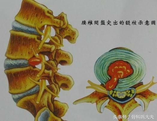 腰间盘膨出贴什么膏最好,腰间盘膨出可以做深蹲吗