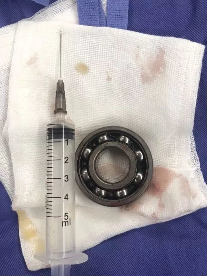 后生仔“命根子”被这个东西套住，越来越肿大！原因……