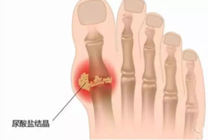 痛风发作时抹什么药膏好,痛风发作需要敷药吗