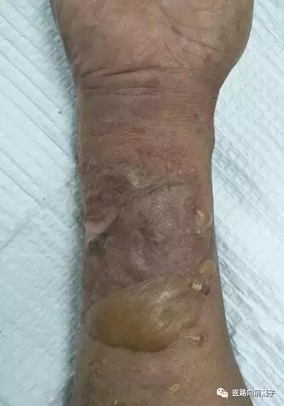 狗咬伤用什么药最有效,小孩被狗咬伤偏方