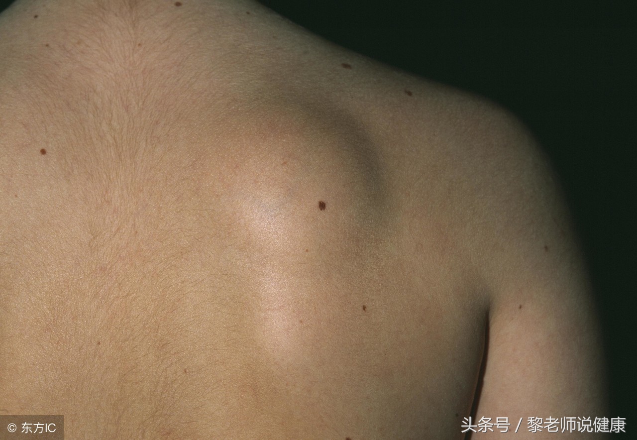长了好几个皮下脂肪瘤,长了4年的脂肪瘤居然恶化了