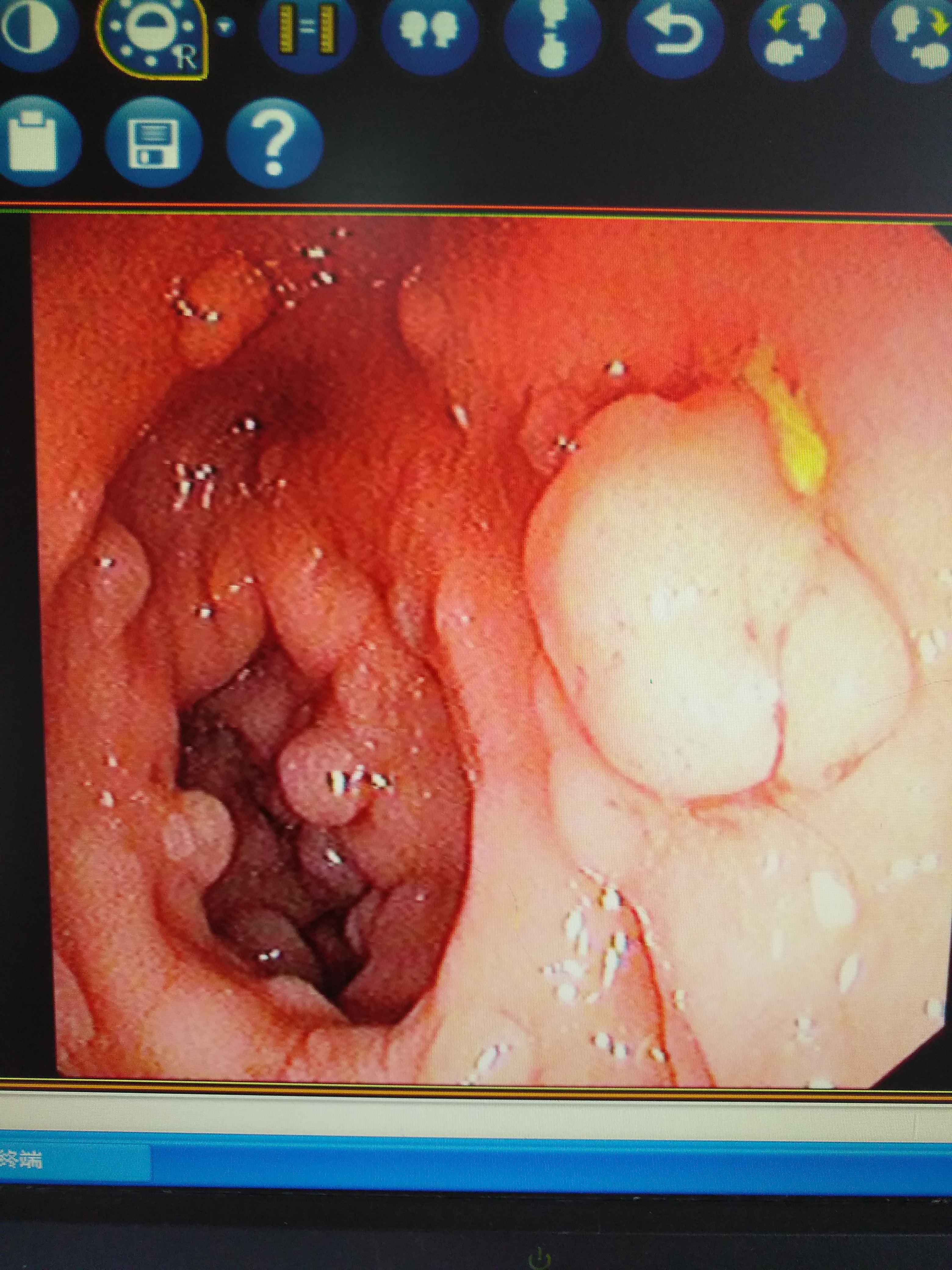 体检发现肠息肉病例,年轻女性查出肠息肉