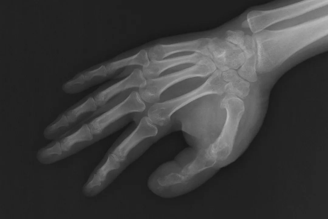 妙龄女子患上巨指症，专家画了一张图让她很惊喜！