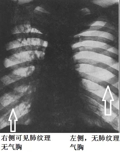 这样的气胸不少见，胸腔穿刺需谨慎！