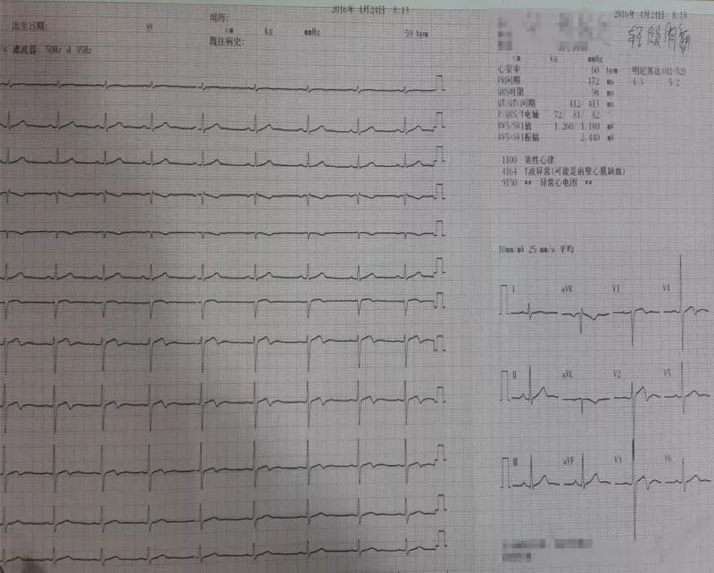 发作性胸痛心电图正常,心电图轻度T波改变图片