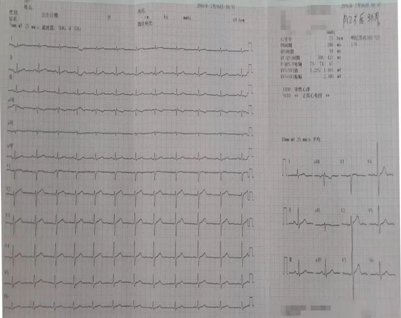 发作性胸痛心电图正常,心电图轻度T波改变图片