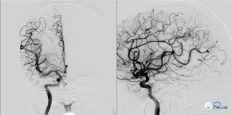 基底动脉闭合手术,基底动脉闭塞取栓一直昏睡