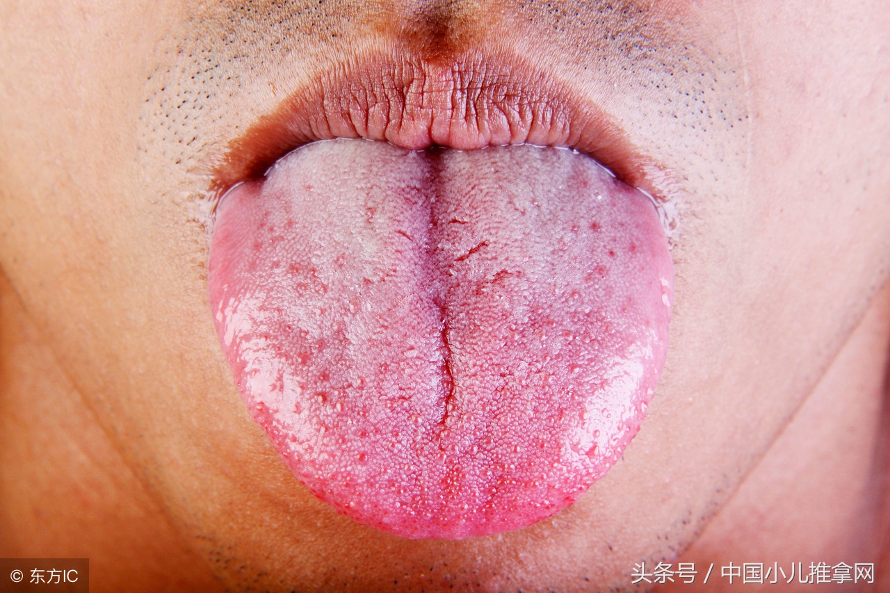 孩子舌苔重怎么推拿,孩子舌苔发黄怎么推拿