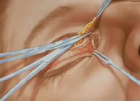 双眼皮怎样做得深一点,双眼皮要做得好看不简单