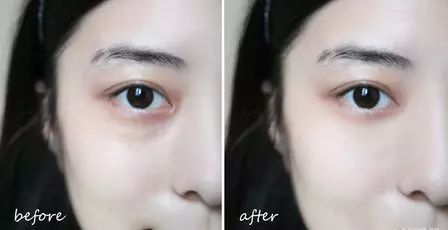 30岁眼角笑起来有皱纹,眼角笑起来有皱纹是老了吗