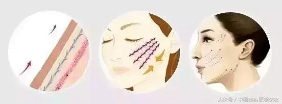 做完线雕为啥不到1月感觉脸垮掉,线雕之后脸会不会垮掉