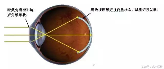 小孩近视去视力矫正中心有用吗,同仁医院看近视眼全过程