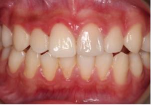 怎么拯救牙齿最快最有效,如何拯救牙齿