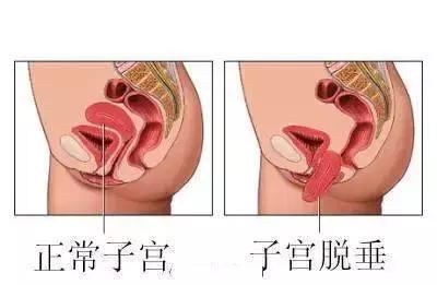 生完孩子小便总感觉一直有尿,生完孩子后总爱尿裤子怎么办