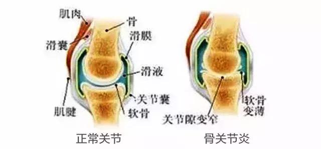 治疗骨关节炎有没有特效药？吃什么药最好？
