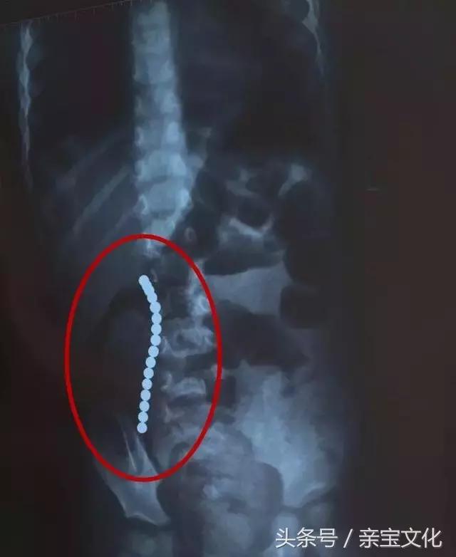 女童2岁一直吐怎么解决,2岁小孩一天吐了五六次咋回事