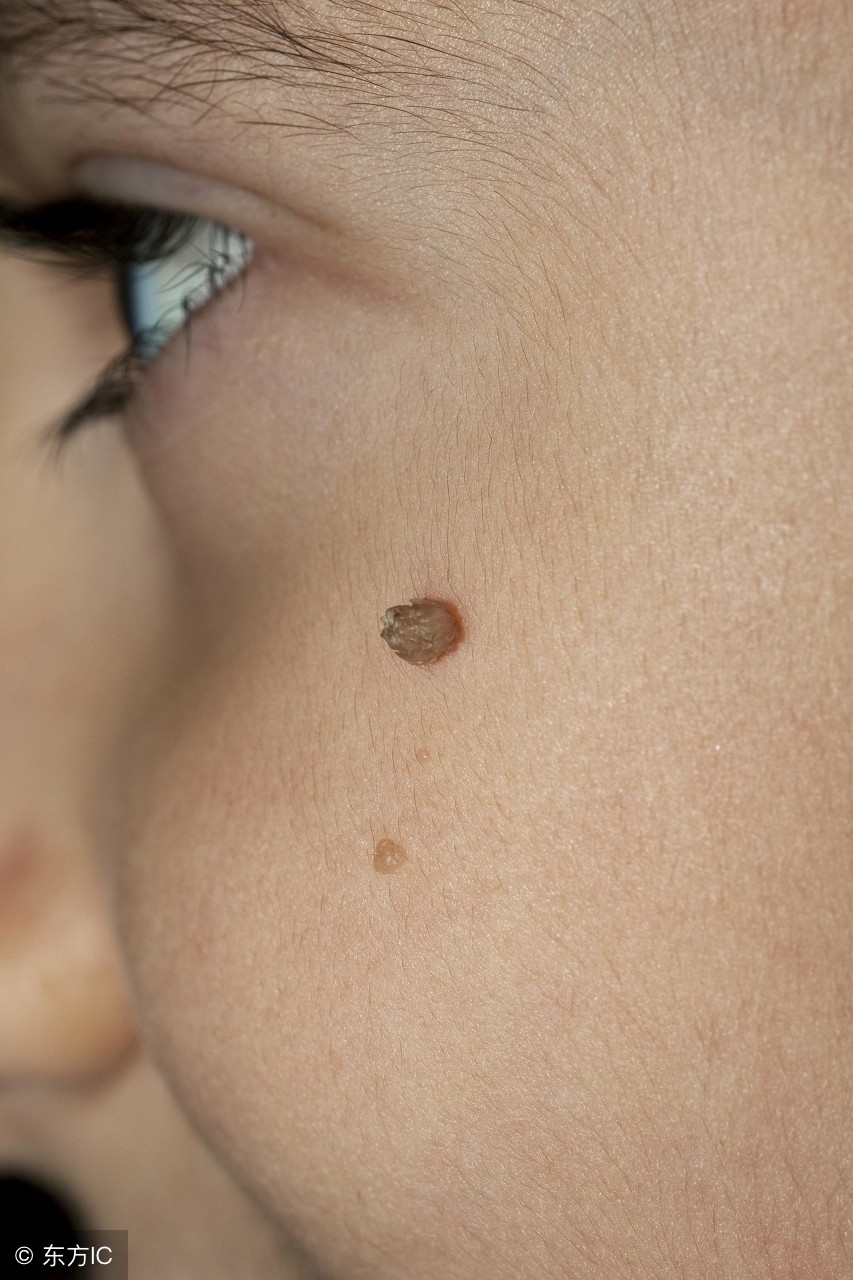 寻常疣怎么预防传染给家人,预防寻常疣可以接种疫苗吗