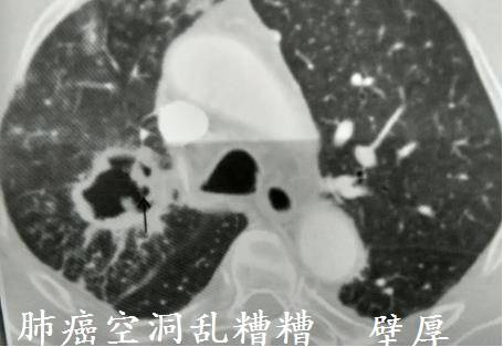 ct诊断肺癌肺结核,ct诊断出肺结核准确率高吗