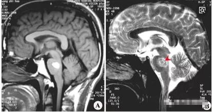 脑出血分期及影像学表现,脑出血各个部位的临床表现