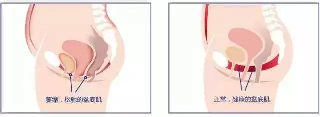 盆底肌:一胎不修复,二胎损伤更大!