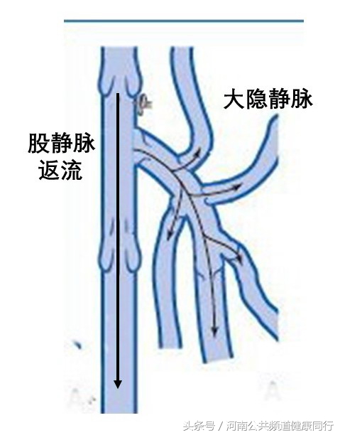 静脉曲张郑大一附院看哪个科,郑大一附院硬化剂治疗静脉曲张