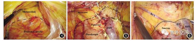 腹腔镜右半结肠癌手术步骤,腹腔镜右半结肠癌