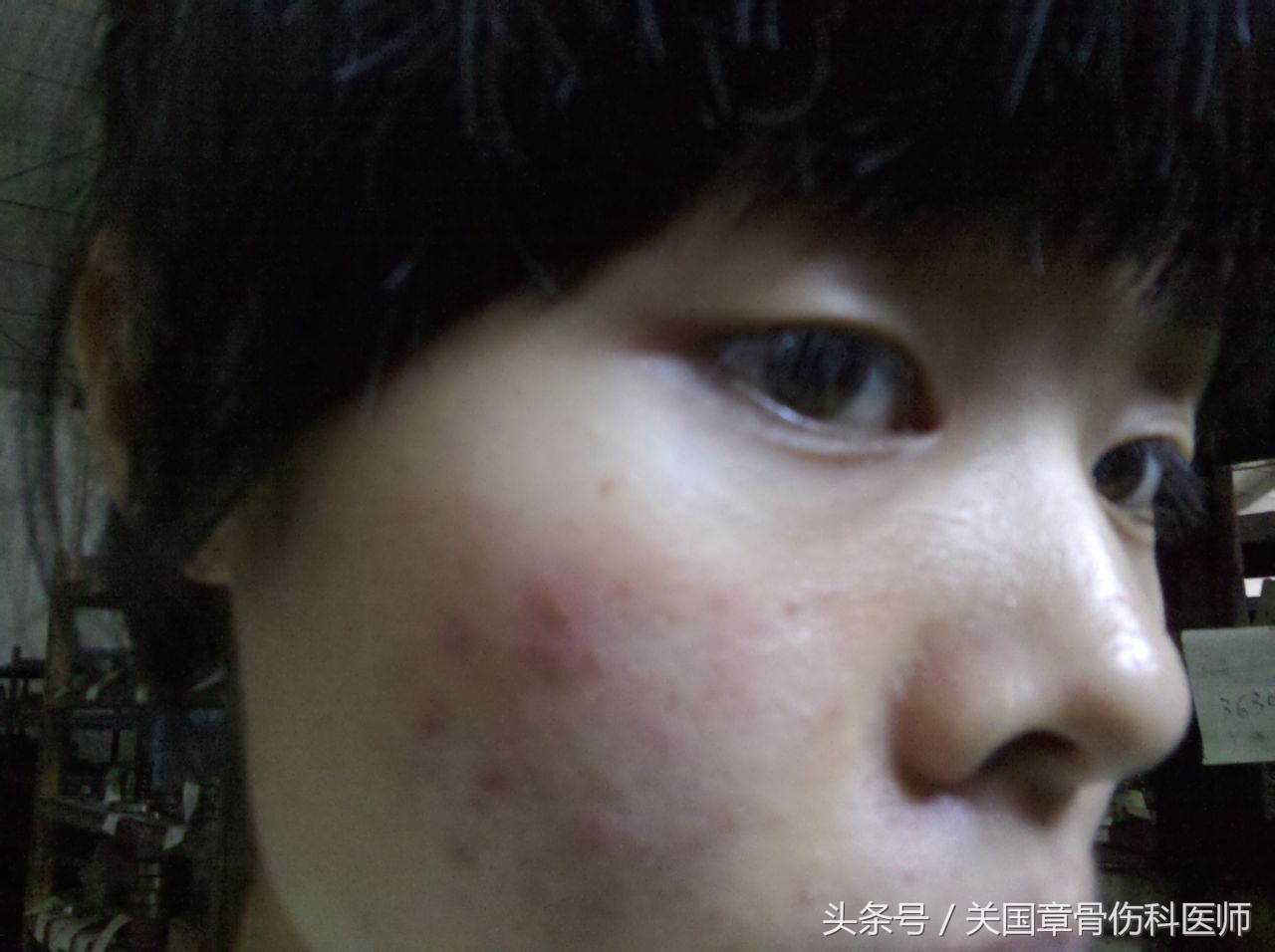 疮痈治疗,痘疮中药怎么治