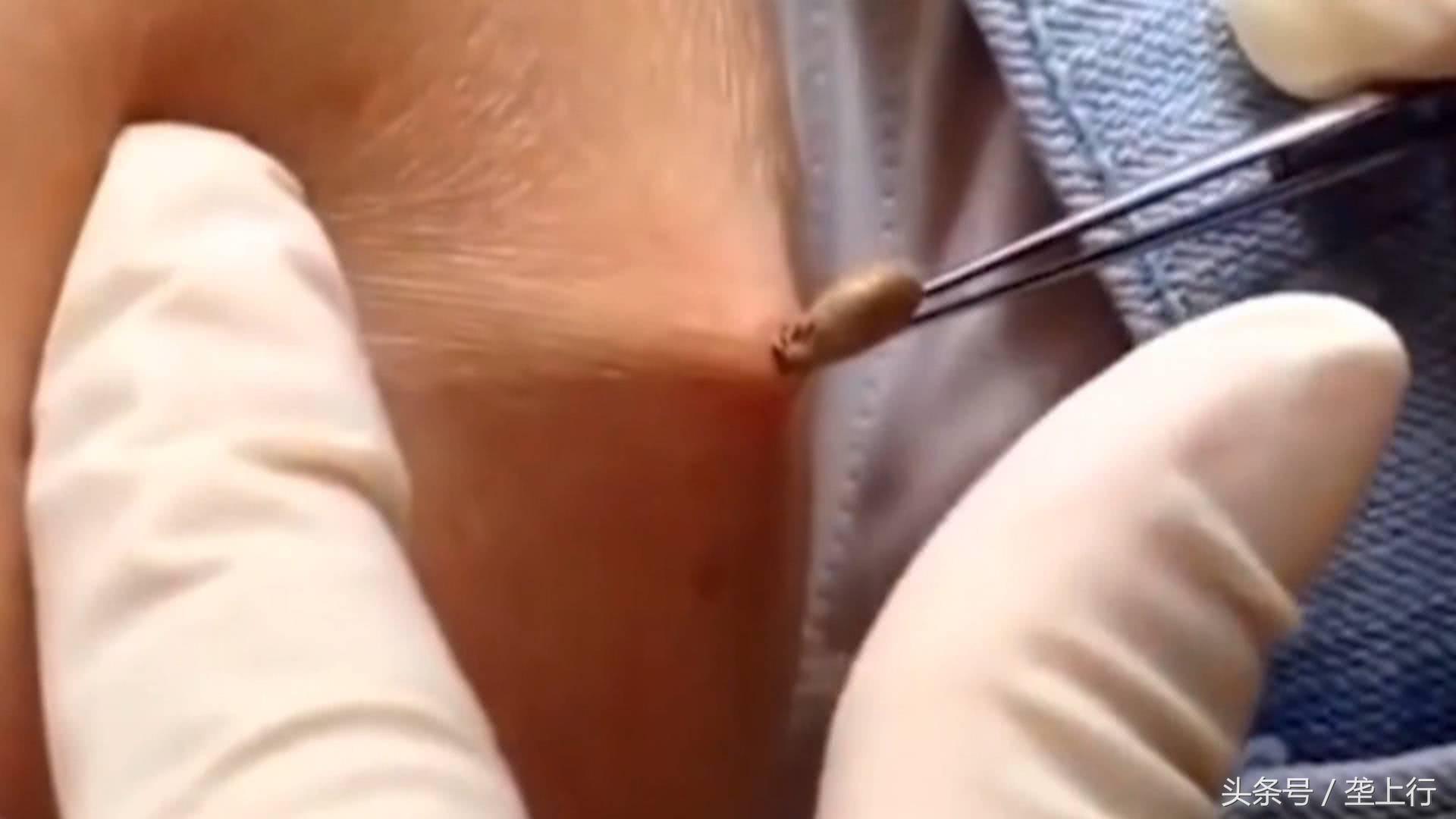 蜱虫叮咬发病有什么后果,蜱虫咬伤症状