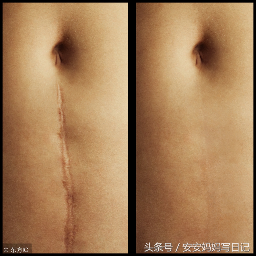 剖腹产后会有哪些并发症,剖腹产后痛有什么更好的方法