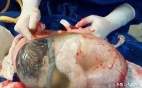 25岁孕妇产下8斤男孩,23岁孕妈妈剖腹产大出血