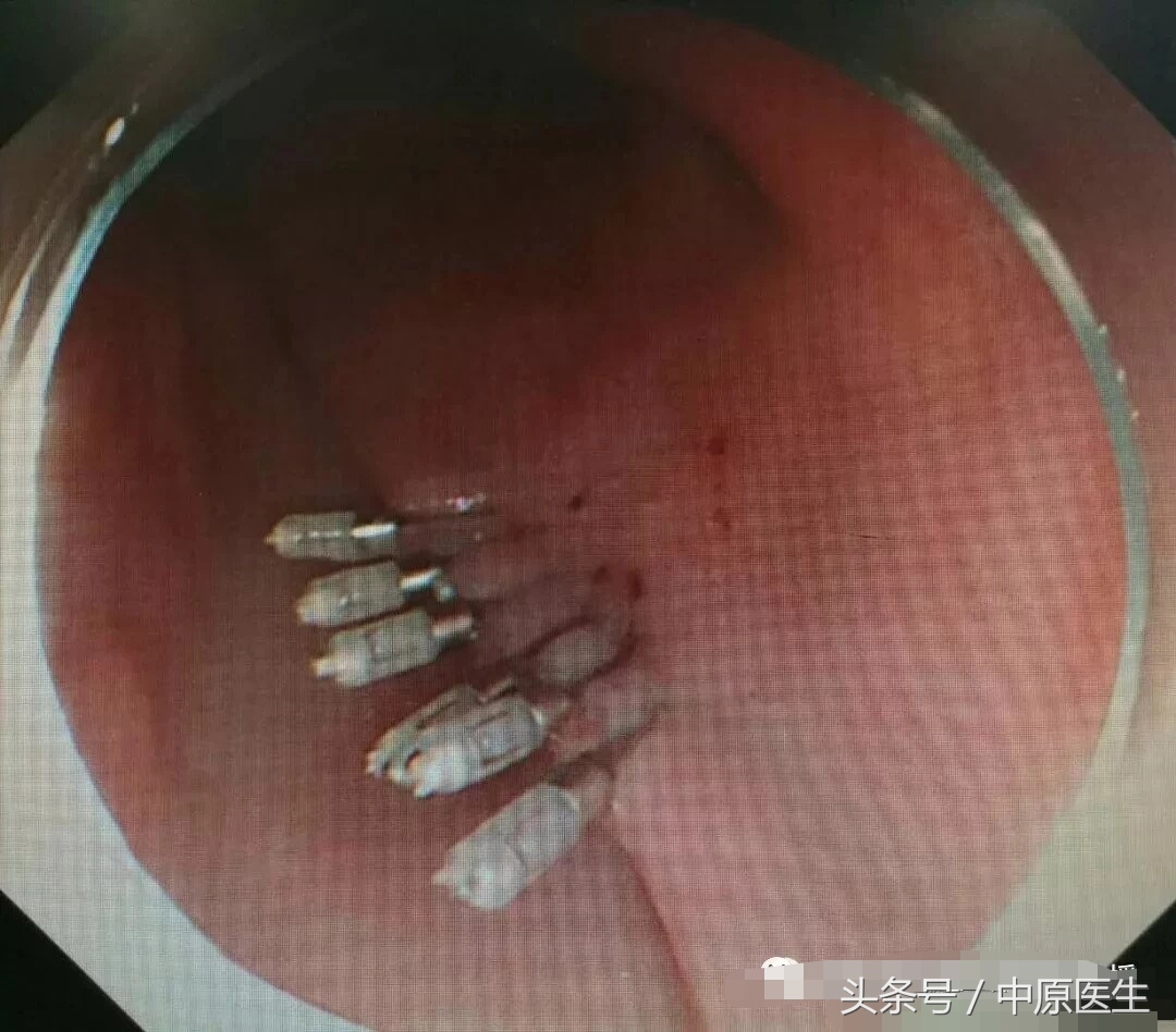 “挖窟窿”新进展：内科医生也耍手术刀，在食管开口切肿瘤