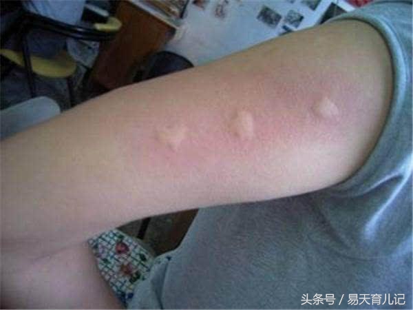 宝宝身上莫名起蚊子咬的小红疙瘩,宝宝身上有点小红点