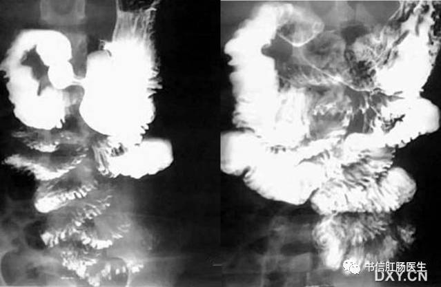 10种经典肠道影像征象：绳征、串珠征、螺纹征……你听过几个？