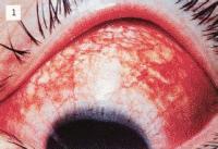 急性结膜炎的治疗心得,急性结膜炎的临床表现及治疗原则