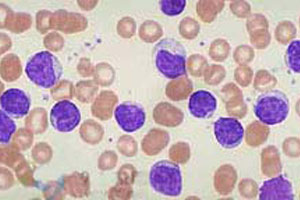 慢性白血病格列卫,慢性粒细胞白血病格列卫