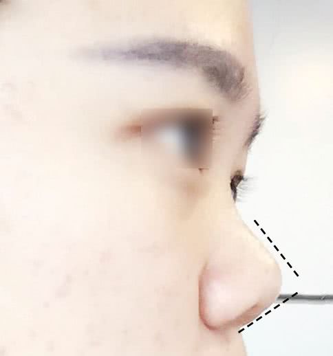 不动手术有哪些隆鼻方法,不动刀的隆鼻好方法