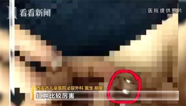 万万没想到！男孩*体下**竟被它紧紧夹住，用手怎么取都取不下！而这回不是拉链裤！